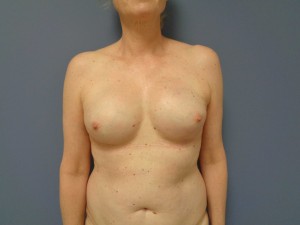 Breast Reconstruction Before and After Pictures Nashville, TN