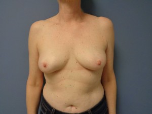 Breast Reconstruction Before and After Pictures Nashville, TN