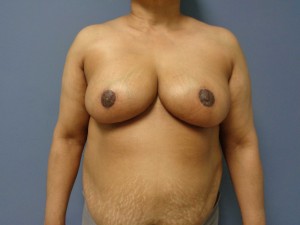 Breast Reduction Before and After Pictures Nashville, TN