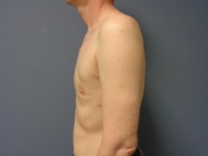 Gynecomastia Before and After Pictures Nashville, TN