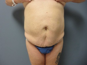 Tummy Tuck Before and After Pictures Nashville, TN