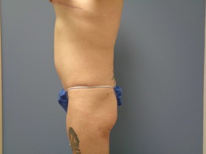 Tummy Tuck Before and After Pictures Nashville, TN