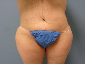 Body Lift Before and After Pictures Nashville, TN