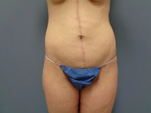 Body Lift Before and After Pictures Nashville, TN