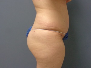 Body Lift Before and After Pictures Nashville, TN