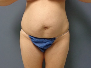 Body Lift Before and After Pictures Nashville, TN