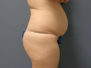 Body Lift Before and After Pictures Nashville, TN