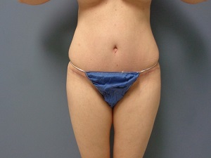 Body Lift Before and After Pictures Nashville, TN