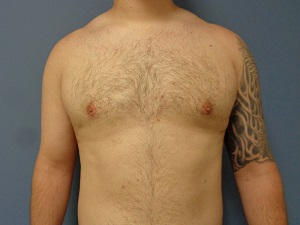 Gynecomastia Before and After Pictures Nashville, TN