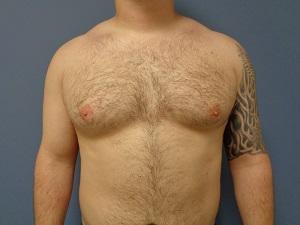 Gynecomastia Before and After Pictures Nashville, TN