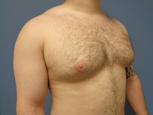Gynecomastia Before and After Pictures Nashville, TN