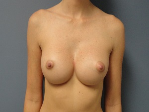 Breast Augmentation Before and After Pictures Nashville, TN