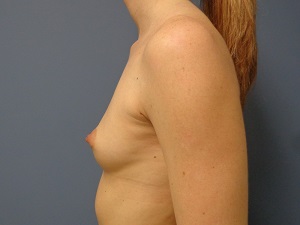 Breast Augmentation Before and After Pictures Nashville, TN