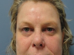 Blepharoplasty Before and After Pictures Nashville, TN