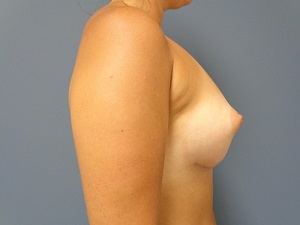 Breast Augmentation Before and After Pictures Nashville, TN