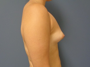 Breast Augmentation Before and After Pictures Nashville, TN