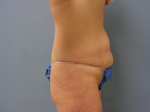 Tummy Tuck Before and After Pictures Nashville, TN