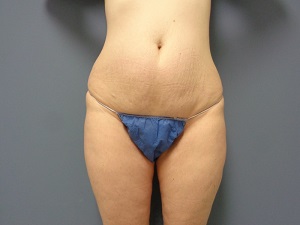 Tummy Tuck Before and After Pictures Nashville, TN