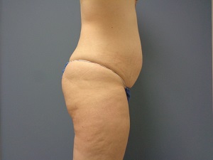 Tummy Tuck Before and After Pictures Nashville, TN
