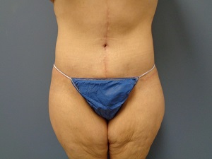 Body Lift Before and After Pictures Nashville, TN