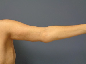 Arm Lift Before and After Pictures Nashville, TN