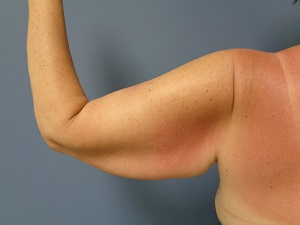 Arm Lift Before and After Pictures Nashville, TN