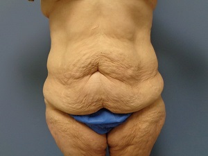 Body Lift Before and After Pictures Nashville, TN