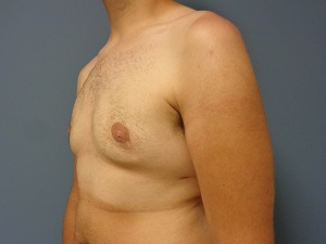 Gynecomastia Before and After Pictures Nashville, TN