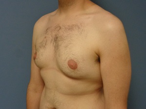 Gynecomastia Before and After Pictures Nashville, TN