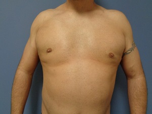 Gynecomastia Before and After Pictures Nashville, TN