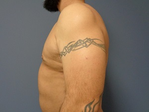 Gynecomastia Before and After Pictures Nashville, TN