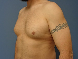 Gynecomastia Before and After Pictures Nashville, TN