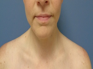 Neck Lift Before and After Pictures Nashville, TN