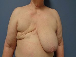 Breast Reconstruction Before and After Pictures Nashville, TN