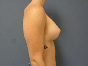 Breast Augmentation Before and After Pictures Nashville, TN