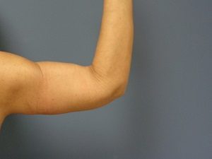 Arm Lift Before and After Pictures Nashville, TN