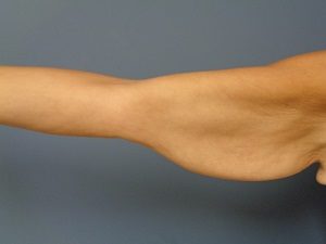 Arm Lift Before and After Pictures Nashville, TN