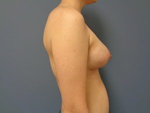 Breast Augmentation Before and After Pictures Nashville, TN