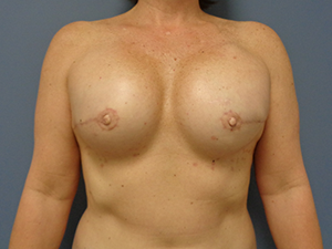 Breast Augmentation Before and After Pictures Nashville, TN