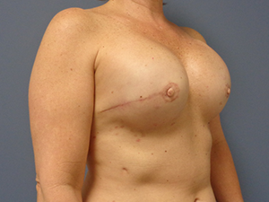 Breast Augmentation Before and After Pictures Nashville, TN