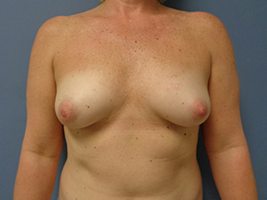 Breast Augmentation Before and After Pictures Nashville, TN