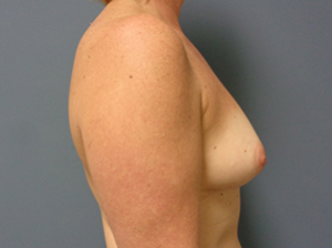 Breast Augmentation Before and After Pictures Nashville, TN