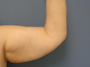 Arm Lift Before and After Pictures Nashville, TN