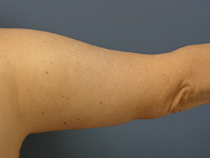 Arm Lift Before and After Pictures Nashville, TN