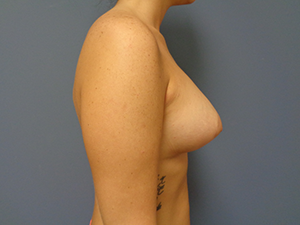 Breast Augmentation with Lift Before and After Pictures Nashville, TN