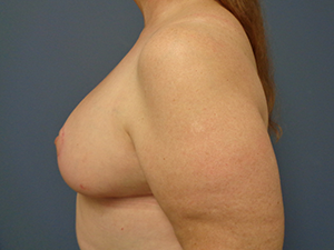 Breast Reduction Before and After Pictures Nashville, TN
