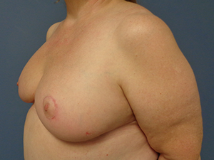 Breast Reduction Before and After Pictures Nashville, TN