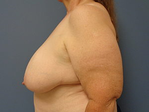 Breast Reduction Before and After Pictures Nashville, TN