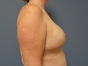 Breast Augmentation Before and After Pictures Nashville, TN