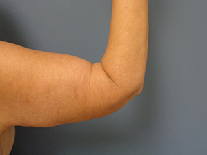 Arm Lift Before and After Pictures Nashville, TN